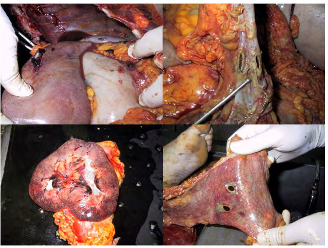 Figure 3: Fatty tissue behind the left kidney.