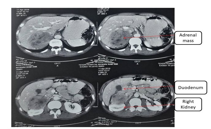 Figure 1: Axial view contrast enhanced CT scan show right adrenal mass 8×7cm. The mass has heterogeneous areas, areas of necrosis, pushing right kidney, renal vein downwards, laterally and posteriorly.