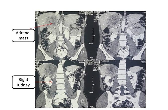 Figure 2: Saggital view of Contrast enhanced CT scan show right adrenal mass 8×7 cm. The mass has heterogeneous areas, areas of necrocis, pushing right kidney, renal vein downwards, laterally and posteriorly.