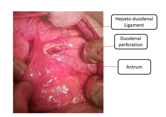 Figure 3: Intraoperative photograph duodenal preforation in 1st part along with scarring and adhesions around duodenum.