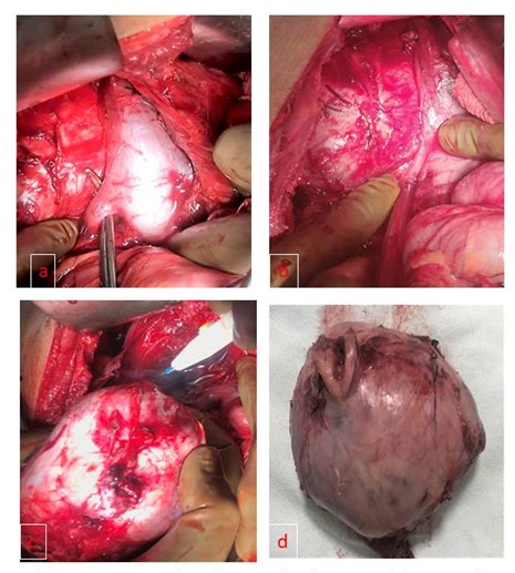 Figure 4: Intraoperative photograph A-B. Tumor lying posterior and lateral to IVC, peritoneum incised, C. Tumor being separated from lateral attachment, D. Excised adrenal tumor.
