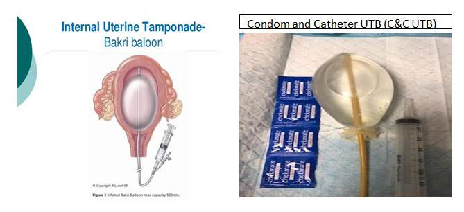 Figure 2: UTB low cost versions. Catheter and condom the bedside manufactured life saver.