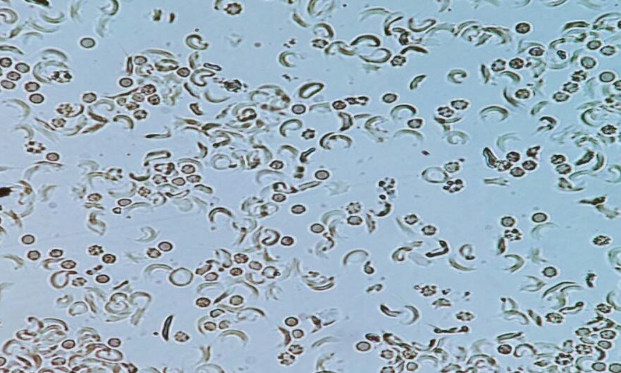 Figure 2: Positive Sickling Test 10X.