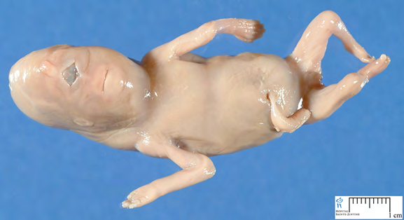 Figure 1: Picture of the fetus with Cyclopia syndrome.