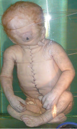 Figure 2: Image of human with cyclopia syndrome with indicative features.