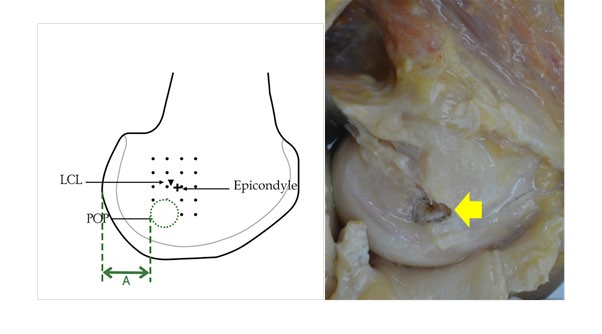 Figure 2: The Footprint of Potential Tendon (Yellow arrow). A is the distance between the posterior rim of popliteal tendon origin and posterior border of the lateral LCL is lateral collateral ligament and POP is popliteal tendon.
