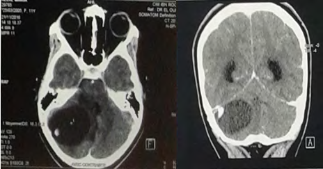 Figure 1: Non-injected cerebral CT scan (a) showing a cystic tumor process of the right cerebellar hemisphere compresses the 4th Ventricle and is responsible for moderate tri-ventricular hydrocephalus with evidence of transepandal resorption. And on cerebral CT with injection (b and c): the enhancement of a solid portion.