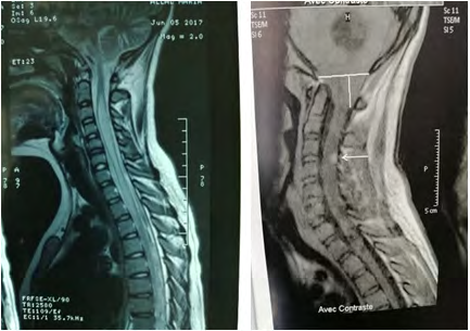 Figure 3: Medullary MRI found a medullary nodule L3-L4 described in hyposignal T2 and strongly enhanced after injection of contrast product with syringomyelic cavity.