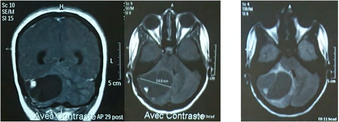 Figure 4: Cerebral MRI control showing a recurrence of the lesion.