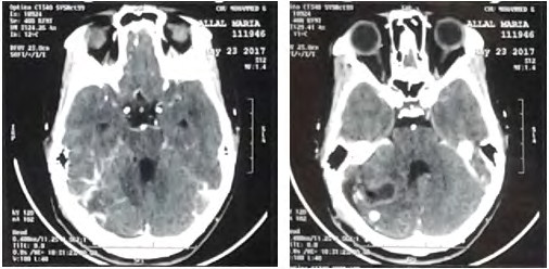 Figure 5: Postoperative CT scan of reoperation of recurrence showing a residual cavity.