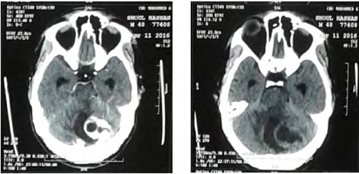 Figure 6: T1-weighted brain MRI after gadolinium found a tumor process in the right cerebellar hemispherr, of 47 mm in diameter, predominantly hypo-intense cystic portion, compressing the 4th Ventricle with a wall nodule hyper signal in injected T1.
