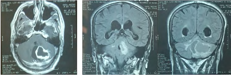 Figure 7: cerebral CT with (a) and without (b) contrast product showing a left cerebellar solido-cystic process of 40 mm in diameter, the wall of which is strongly raised after injection of contrast product, and compressing the 4th ventricle.