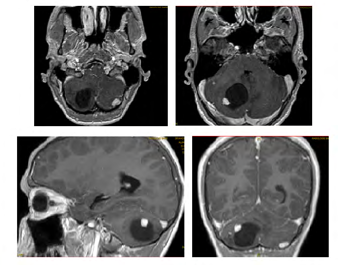 Figure 8: T1-MRI with injection shows a left cerebellar process intensely enhancing the periphery, responsible for a tri-ventricular hydrocephaly associated with hyperintense peri-lesional edema on T2 Flair sequences.