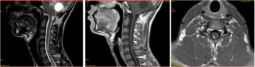 Figure 9: T1-weighted brain MRI after gadolinium injection showed: tumor processes nodular and nodulo- cystic tumor processes with a hypo-intense cyst and a hypersignal tissue portion in the left cerebellar hemisphere with midline deviation.