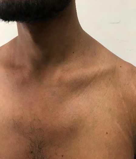 Figure 4: Picture after completion of treatment showing significant reduction of swelling.