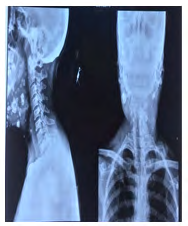 Figure 2: Skiagram of the airway – Lateral and Antero- posterior view.