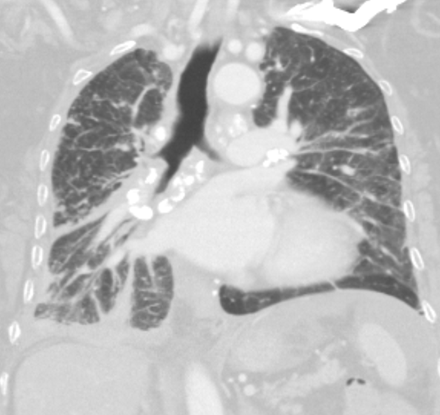 Figure 1: Multiple pleural based and peri-bronchovascular nodular densities with interlobar fissural thickening and nodularity.