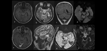 Figure 3: MRI brain images showing large lobulated focus within left temporal region returning T2 hypointense (b) and T1 isointense signals (a), it is showing signal dropout along its rim on SWI sequence (g), it is also showing minimal post contrast (e), Associated focal dural enhancement is also seen (e).