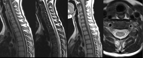 Figure 4: MRI cervical spine images in which cervical spinal cord is showing abnormal T2 hyperintense signal areas involving the anterior as well as posterior horns bilaterally throughout the extent of visualized spinal cord. These areas are showing subtle post contrast enhancement.
