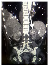 Figure 2: The left renal cortical abscess in the lower pole (smaller arrow) along with the multiple stones (the bigger arrow).