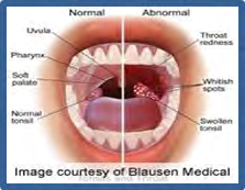 Figure 4: Normal vs cancer mouth.