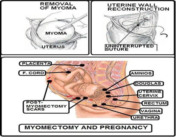 Figure 1: Myomectomy and Pregnancy.