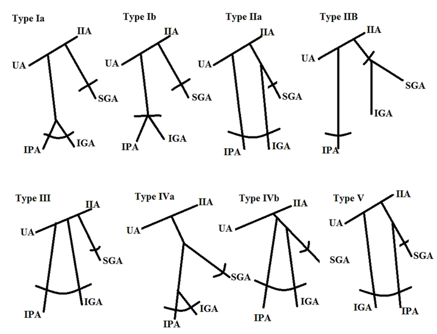 Figure 2: Adachi’s types of IIA variations. IIA: internal iliac artery; IGA: Inferior gluteal artery; IPA: Internal pudendal artery; SGA: Superior gluteal artery; UA: Umbilical artery [9].