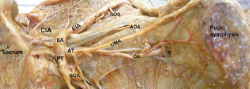 Figure 3: The obturator artery arising from the anterior trunk of the internal iliac artery. CIA: common iliac artery; EIA: external iliac artery; IIA: internal iliac artery; IEA: inferior epigastric artery; OA: obturator artery [10].