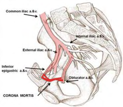 Figure 4: Corona mortis, Lateral view [18].