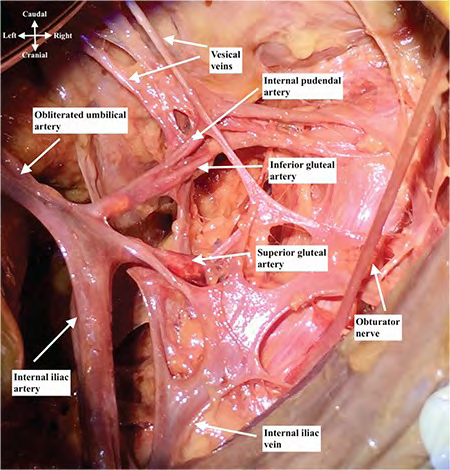 Figure 5: Right Internal artery dissection showing internal pudendal artery, lateral view.