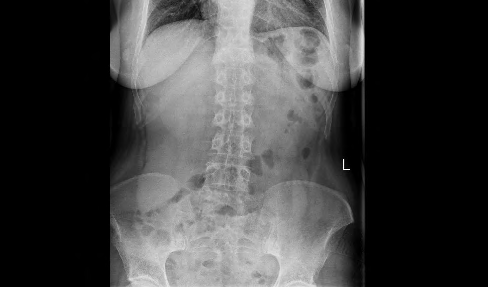 Figure 1: Abdominal X-ray showing hepatomegaly; Liver silhouette is enlarge, has displaced the normal bowel downwards and to the left; distally the liver enlargement is visible under the iliac line.