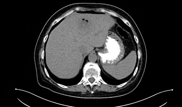 Figure 2: CT- non-contrast. There is a hypodense lesion with a gas containing in 4/2 liver segment.