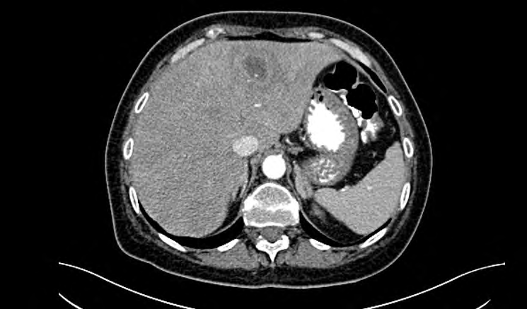 Figure 3: Contrast- enhanced CT- demonstrate central /fluid -filled/ low attenuation lesion with high attenuation inner rim / abscess membrane/ and a low attenuation outer rim / edema of liver parenchyma/-double target sign.