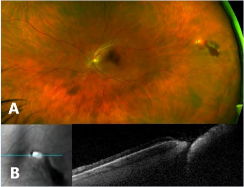 Figure 1: A & B). The patient underwent laser retinopexy and was treated with oral clindamycin and topical moxifloxacin. At her two-month follow up visit, no signs of infection had been noted and vision remained stable (Figure 2).