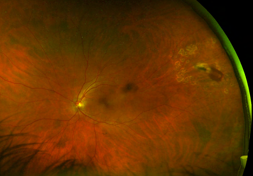 Figure 2: Cat-claw induced occult scleral injury at 2 month follow up post laser retinopexy. Unresolved subretinal hemorrhage and new laser scarring can be seen in the temporal retina.