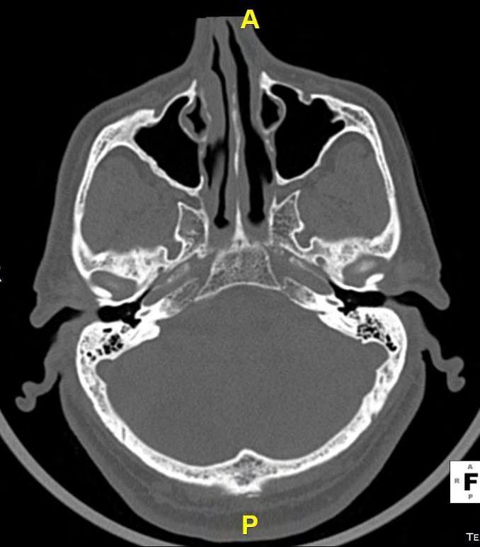Figure 1: Axial section of brain CT bone scan. The maxillary sinus APD is indicated by the arrow.