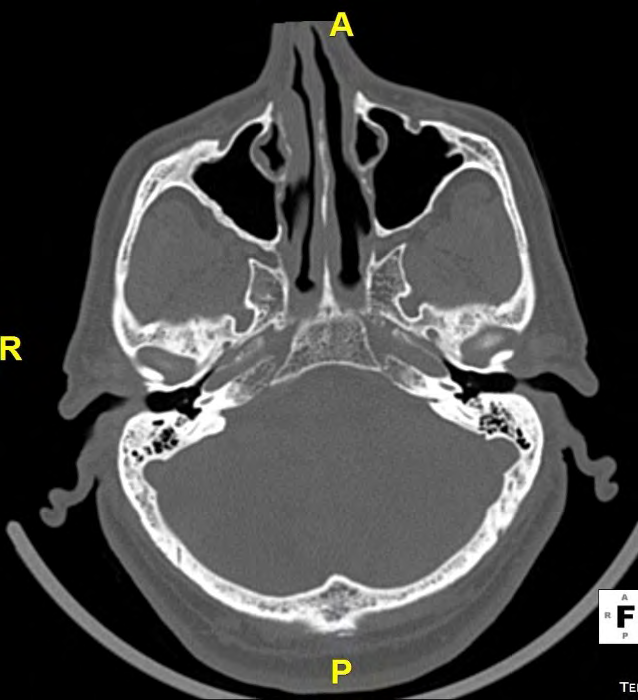 Figure 2: Axial section of brain CT bone scan. The maxillary sinus TD is indicated by the arrow.