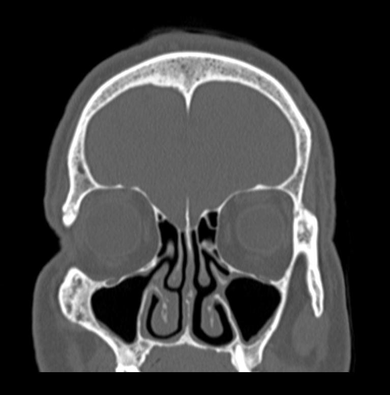 Figure 3: Coronal reconstruction of cerebral CT in bone window. The CCD is measured as indicated by the arrow.