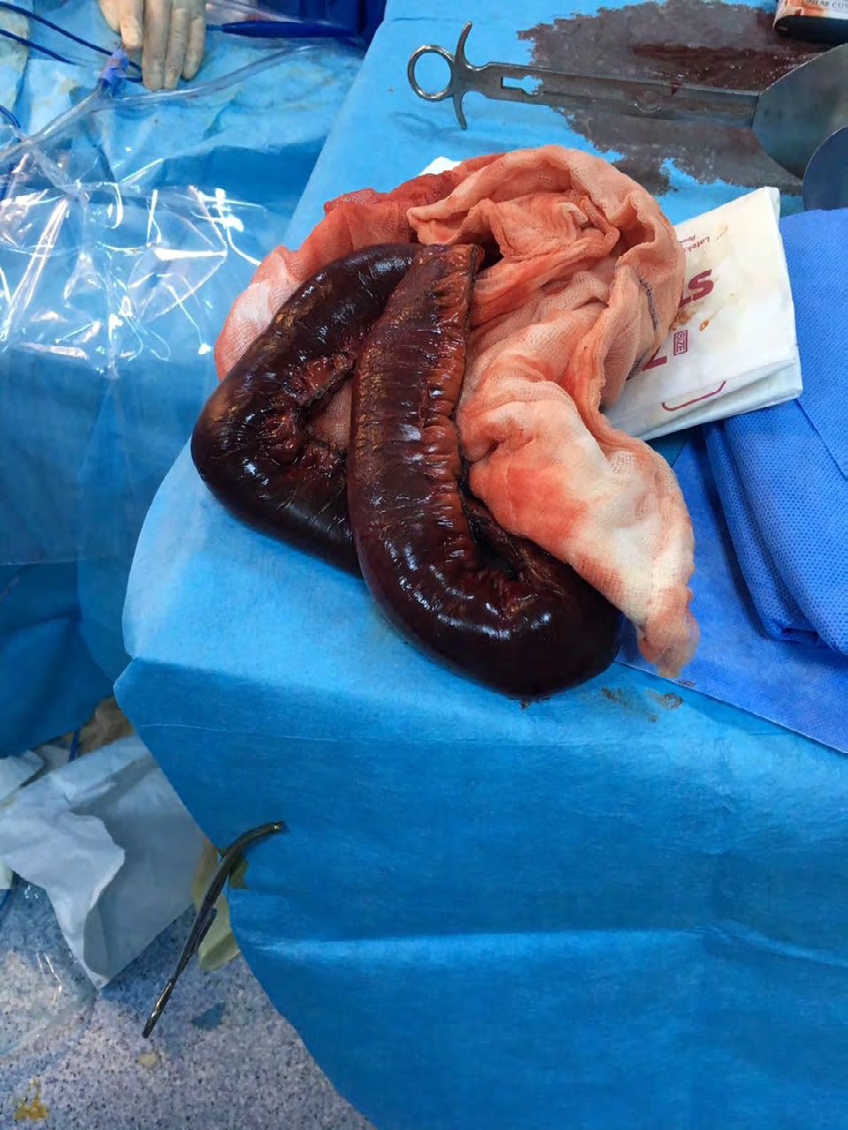 Figure 3: Removed bowel segment.