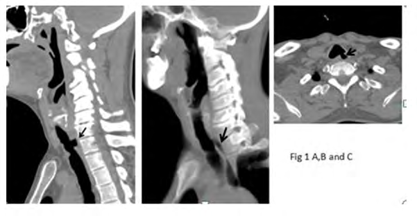 Figure 1: CT images in sagittal and axial planes, Arrows indicate air in esophagus.