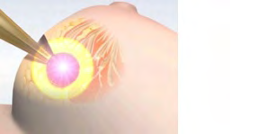 Figure 2: The position of the tumour is determined.