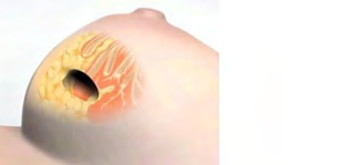 Figure 3: The tumor is surgically removed.