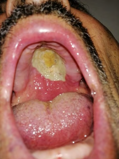 Figure 1: Ulcerative lesion of the hard palate with erythematous soft palate mucosa.