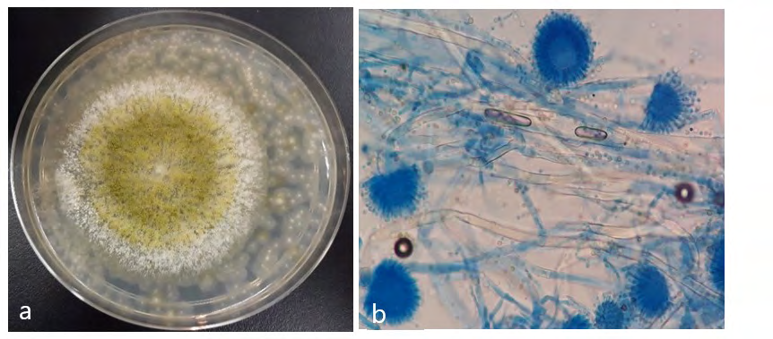 Figure 3: Invasive pulmonary aspergillosis. a) Pulmonary parenchyma with necrosis and pulmonary haemorrhage and Aspergillus hyphae (Haematoxylin and Eosin). b) Branching Aspergillus hyphae involving lung parenchyma (Grocott Methenamine Silver fungus stain) [16].