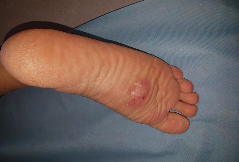Figure 1: Clinical examination revealed subcutaneous nodules, painless, confluent, producing a polylobed tumor appearance with an erythematous-purplish surface, strewn with openings in the sole of the right foot.