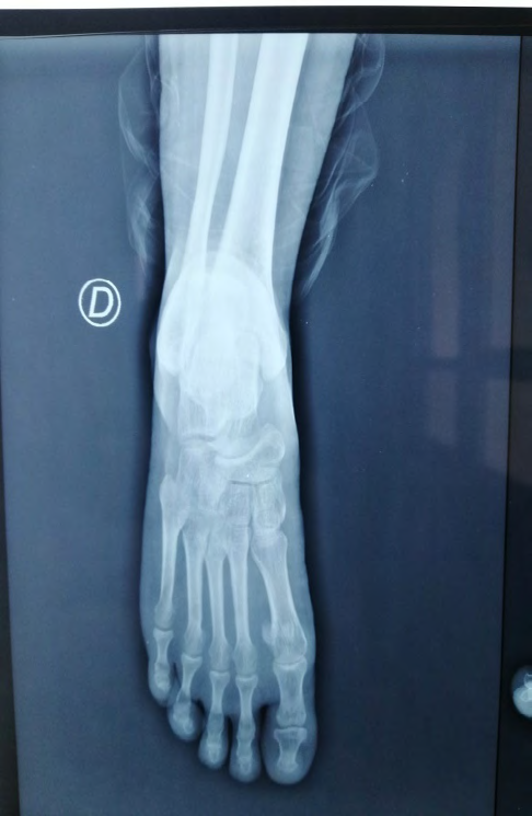 Figure 4: The patient performed an x-ray of the control foot was normal.