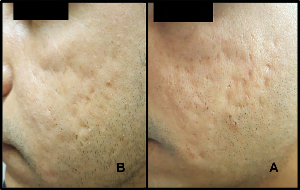 Figure 5: Right side of the face (A) before and (B) after treatment, with marked improvement of acne scars.