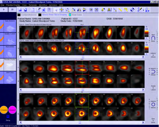 Figure 2: Presence of Viable Myocardium noted with SMRE (study 2), no improvement with NO3 (study 1).
