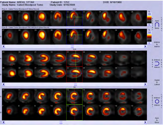 Figure 3: Presence of Viable Myocardium noted with SMRE (study 2), no improvement with NO3 (study 1).