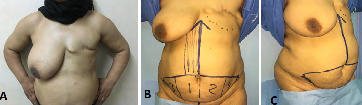 Figure 1: (A, B, C), A. patient with left mastectomy, B and C, anterior and oblique views with marking for 1st stage surgical delay.